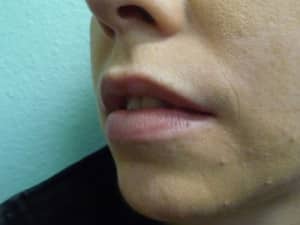 Lip Augmentation