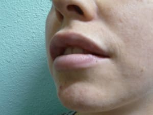 Lip Augmentation Case 8672 After Photo Lip Augmentation