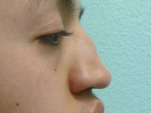 Nose Surgery