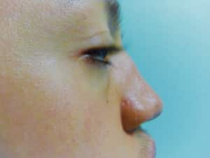 Nose Surgery Case 8668 After Photo Nose Surgery