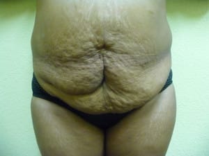 Tummy Tuck