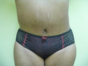 Tummy Tuck