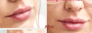Fillers Case 9030 After Photo Fillers