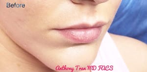 Fillers Case 9030 Before Photo Fillers