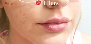 Fillers Case 9030 After Photo Fillers