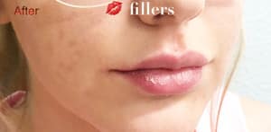 Fillers