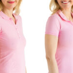 Restoring Breast Beauty: Breast Augmentation and Lift in Mommy Makeovers