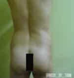 Butt Augmentation