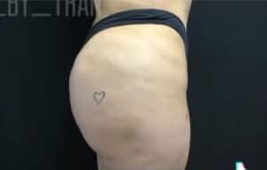 Butt Augmentation Case 14997 After Photo Butt Augmentation