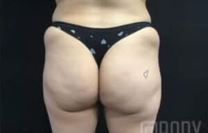 Butt Augmentation Case 14997 Before Photo Butt Augmentation