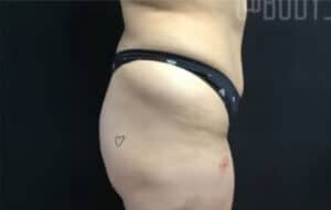 Butt Augmentation Case 14997 Before Photo Butt Augmentation