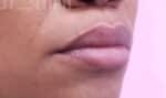Fillers