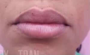 Fillers Case 14995 After Photo Fillers