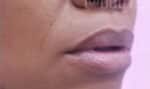 Fillers