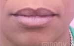 Fillers