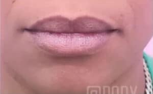 Fillers Case 14995 Before Photo Fillers
