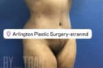 Tummy Tuck