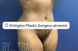 Tummy Tuck Case 14993 After Photo Tummy Tuck
