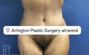 Tummy Tuck Case 14993 After Photo Tummy Tuck