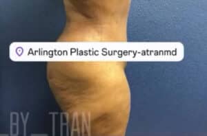 Tummy Tuck Case 14993 After Photo Tummy Tuck