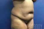 Tummy Tuck