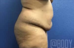 Tummy Tuck Case 14993 Before Photo Tummy Tuck
