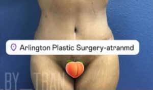 Tummy Tuck Case 15067 After Photo Tummy Tuck