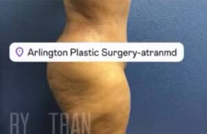Tummy Tuck Case 15067 After Photo Tummy Tuck