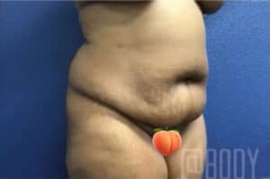 Tummy Tuck Case 15067 Before Photo Tummy Tuck