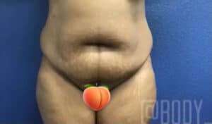 Tummy Tuck Case 15067 Before Photo Tummy Tuck