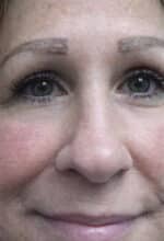 Eye Lid Surgery