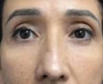 Eye Lid Surgery