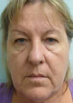 Eye Lid Surgery
