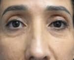 Eye Lid Surgery