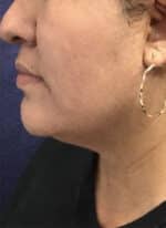 Neck Liposuction