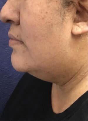 Neck Liposuction