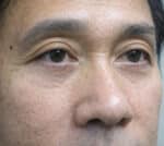Eye Lid Surgery