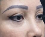 Eye Lid Surgery