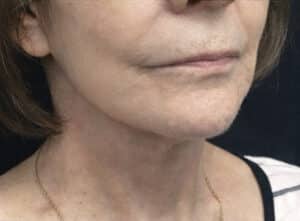 Facelift