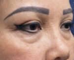Eye Lid Surgery