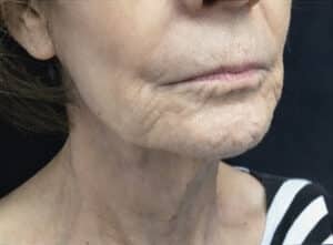Facelift