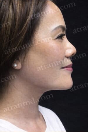 Neck Lifts