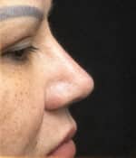 Nose Surgery