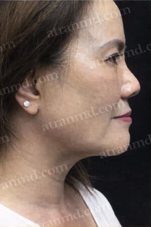 Neck Lifts
