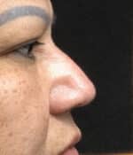 Nose Surgery