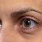 Under-Eye Bag Removal in Arlington, TX