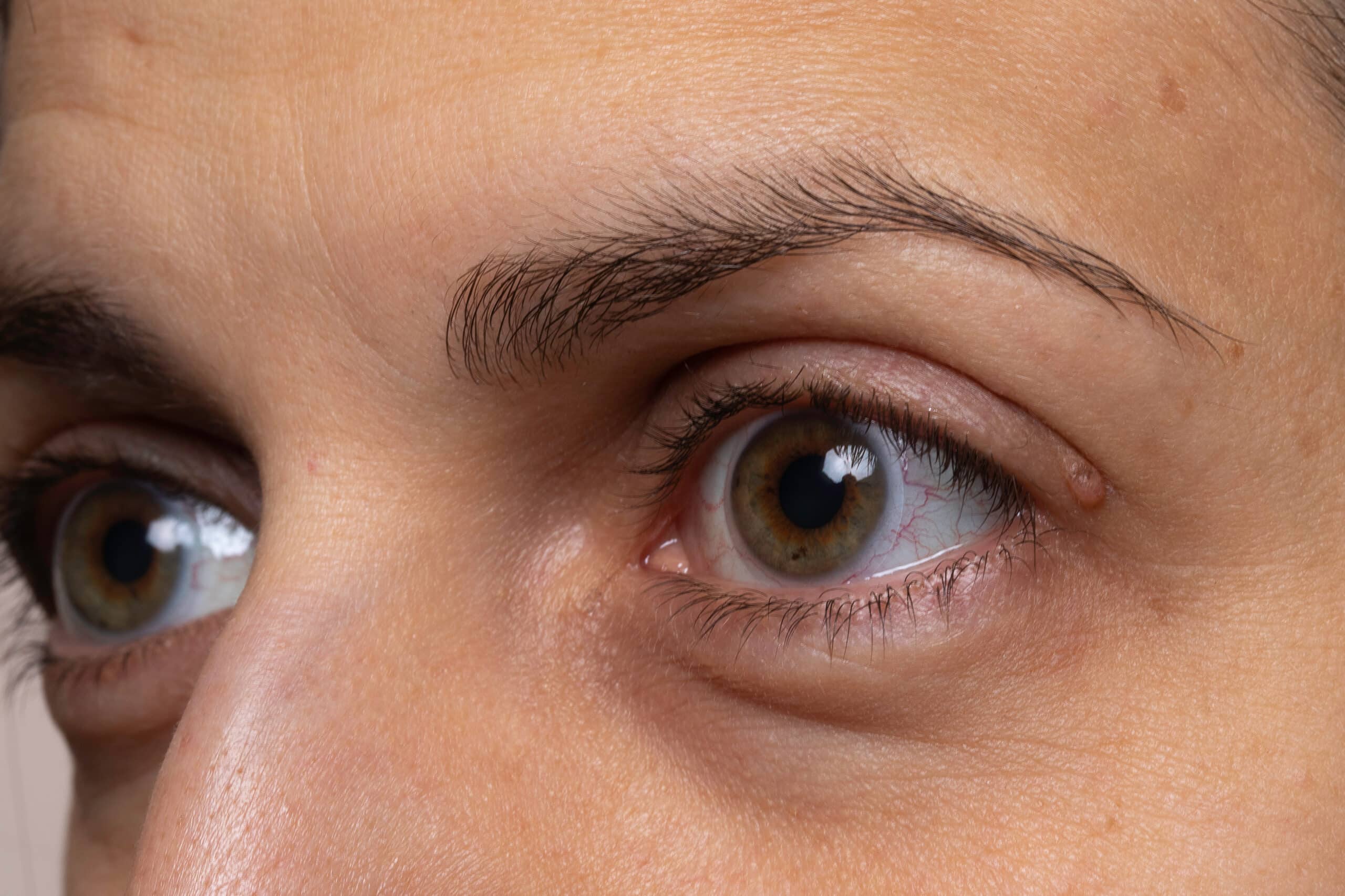 Under-Eye Bag Removal