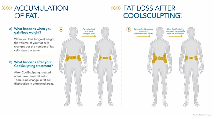 Accumulation-of-Fat-Fat-Loss-After-CoolSculpting