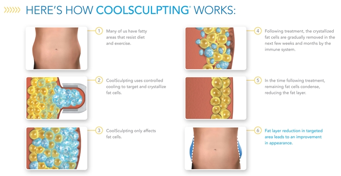 How-CoolSculpting-Works