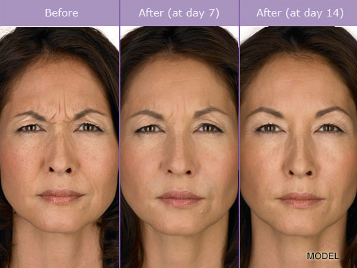 Juvederm-Before-and-After1